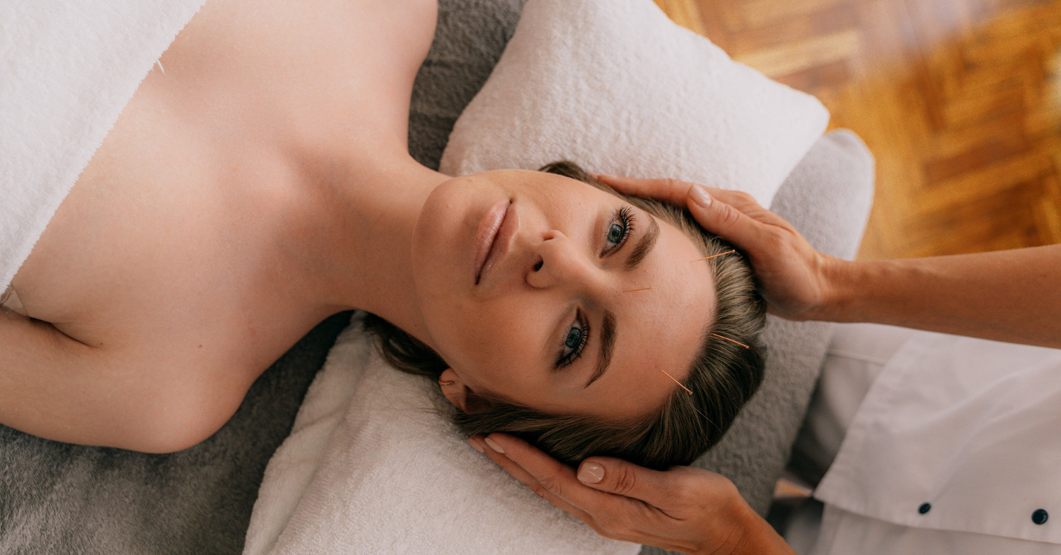 Acupuncture in Migraine Relief